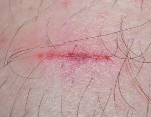 落下による傷を防ぐための予防方法は？